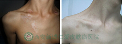 男性手部局限型白癜风案例故事