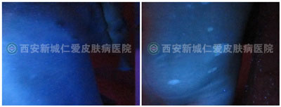 男性手部局限型白癜风案例故事