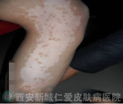 男性手部局限型白癜风案例故事